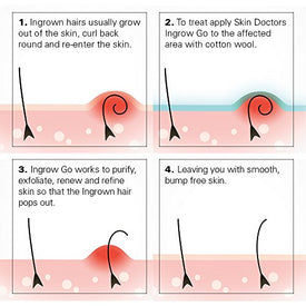 Skin Doctors Ingrow Go Lotion, Lotion pour Poils Incarnés, Appliquer en Prévention sur les Jambes, la Zone du Maillot, les Aisselles et le Visage, 120 ml - Nature Linking